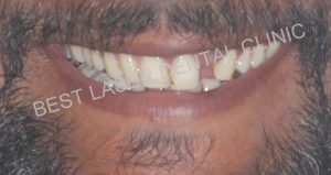 immediate replacement for tooth with periapical lesion