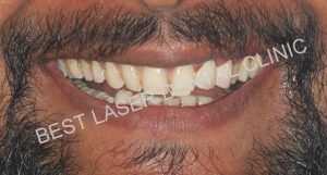 immediate replacement for tooth with periapical lesion