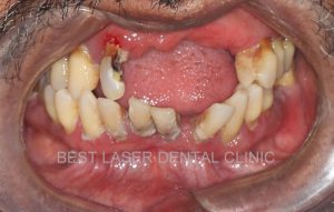 removable denture replacement with basal implants