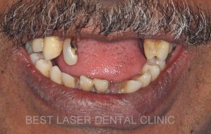 removable denture replacement with basal implants