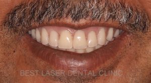 removable denture replacement with basal implants