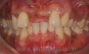 missing front teeth replacement with basal implants