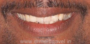 missing front teeth replacement with basal implants