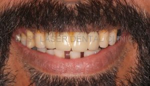 multiple missing and mobile teeth replacement