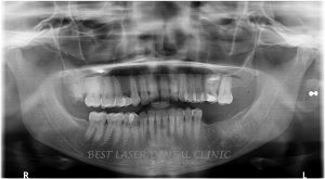 molars replacement