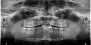 missing front teeth replacement with basal implants