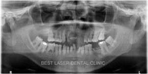 removable denture replacement with basal implants