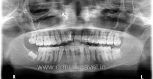 fixed teeth in single day