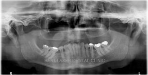 missing teeth replacement