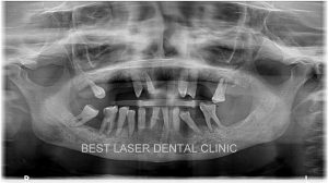 fullmouth replacement