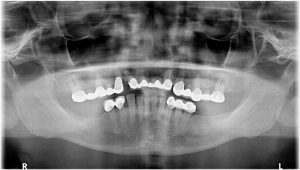 upper teeth replacement