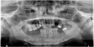 multiple missing teeth replacement