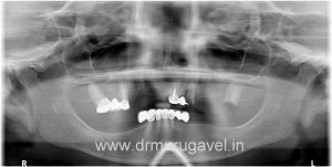 full mouth rehabilitation