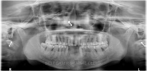 missing lower front tooth replacement