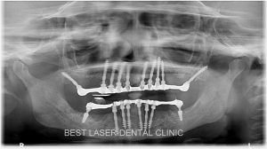 fullmouth replacement