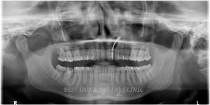 immediate replacement for tooth with periapical lesion