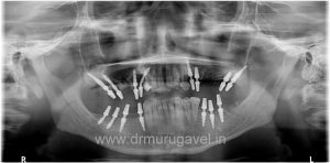 multiple missing teeth replacement