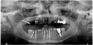 missing lower front teeth replacement