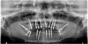 full mouth rehabilitation