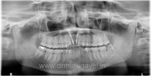 missing front teeth replacement with basal implants