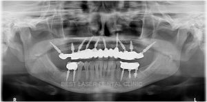 upper teeth replacement