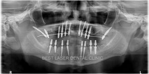 removable denture replacement with basal implants