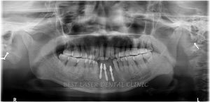 missing lower front tooth replacement