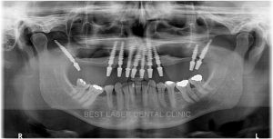 missing teeth replacement