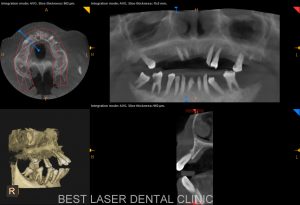 fullmouth replacement with basal implants