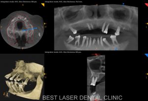 fullmouth replacement with basal implants