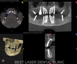 fullmouth replacement with basal implants