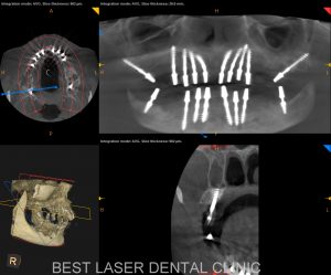 fullmouth replacement with basal implants