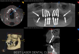 fullmouth replacement with basal implants