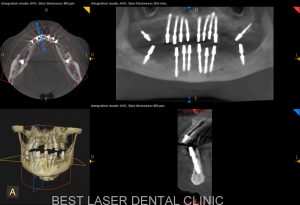 fullmouth replacement with basal implants