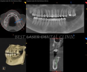 molars replacement