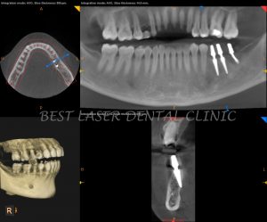 molars replacement