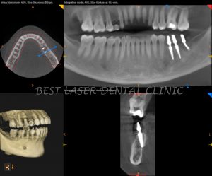 molars replacement