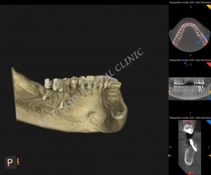 molars replacement