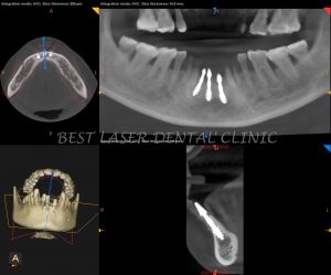 missing lower front tooth replacement