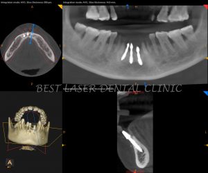 missing lower front tooth replacement