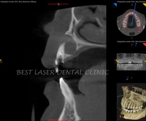 immediate replacement for tooth with periapical lesion