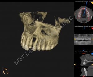 immediate replacement for tooth with periapical lesion