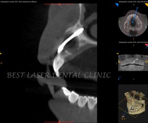 immediate replacement for tooth with periapical lesion