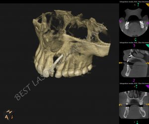 immediate replacement for tooth with periapical lesion