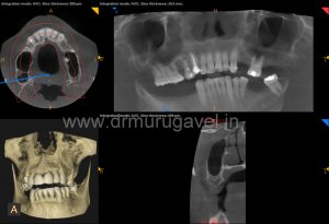 multiple missing teeth replacement