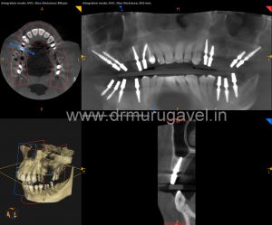 multiple missing teeth replacement