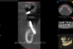 multiple missing teeth replacement