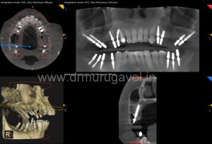 multiple missing teeth replacement