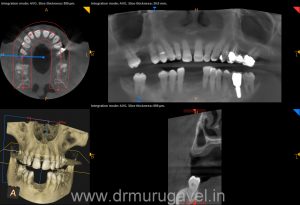 missing lower front teeth replacement