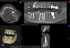 missing lower front teeth replacement